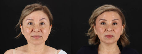 Quantum RF case #263448