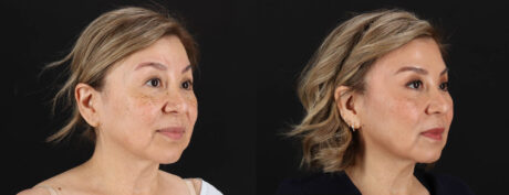 Quantum RF case #263448