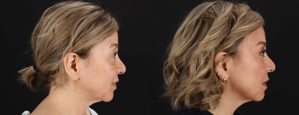 Quantum RF case #263448