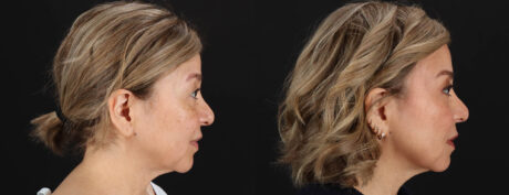 Quantum RF case #263448