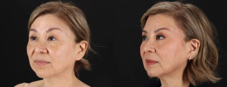 Quantum RF case #263448