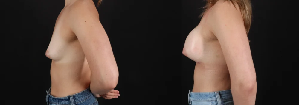 Breast Augmentation case #264418