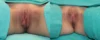 Labiaplasty case #264416 slider thumbnail
