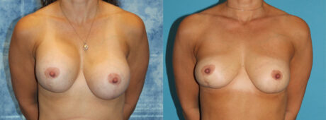 Fat Grafting to the Breast case #264627