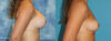 Fat Grafting to the Breast case #264627 slider thumbnail