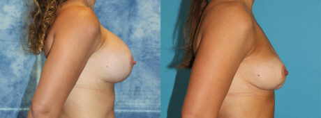 Fat Grafting to the Breast case #264627