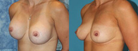 Fat Grafting to the Breast case #264627