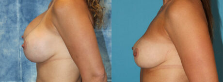 Fat Grafting to the Breast case #264627