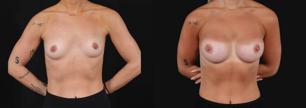 Breast Augmentation case #266366