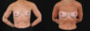 Breast Augmentation case #266366 slider thumbnail