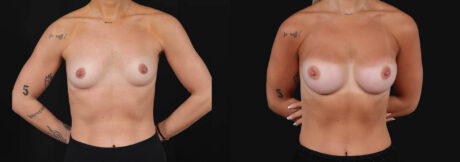 Breast Augmentation case #266366