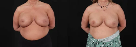 Revision Breast Surgery case #266360