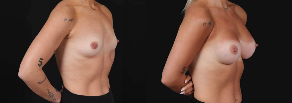 Breast Augmentation case #266366