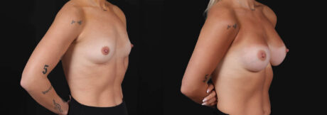 Breast Augmentation case #266366