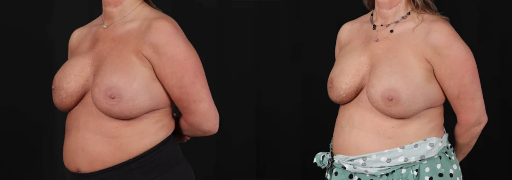 Revision Breast Surgery case #266360