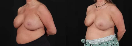 Revision Breast Surgery case #266360