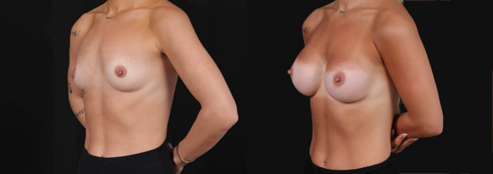Breast Augmentation case #266366