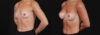 Breast Augmentation case #266366 slider thumbnail