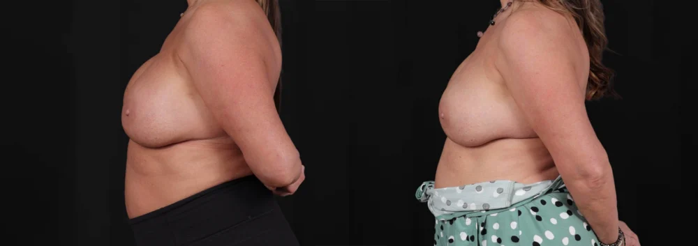 Revision Breast Surgery case #266360