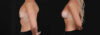 Breast Augmentation case #266366 slider thumbnail
