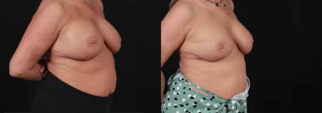 Revision Breast Surgery case #266360