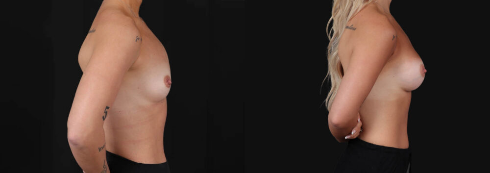 Breast Augmentation case #266366