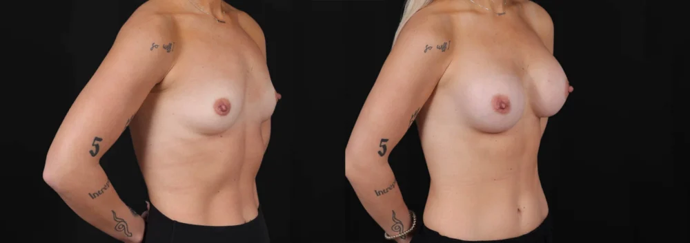 Breast Augmentation case #266366