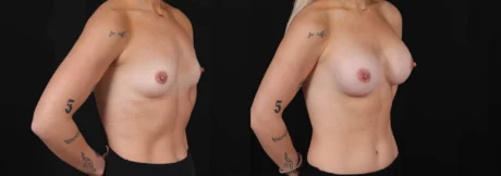 Breast Augmentation case #266366