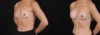 Breast Augmentation case #266366 slider thumbnail