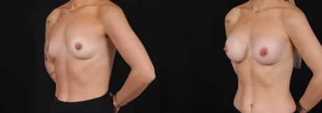 Breast Augmentation case #266366