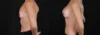 Breast Augmentation case #266366 slider thumbnail