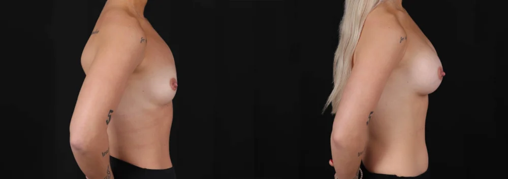 Breast Augmentation case #266366