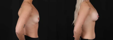 Breast Augmentation case #266366