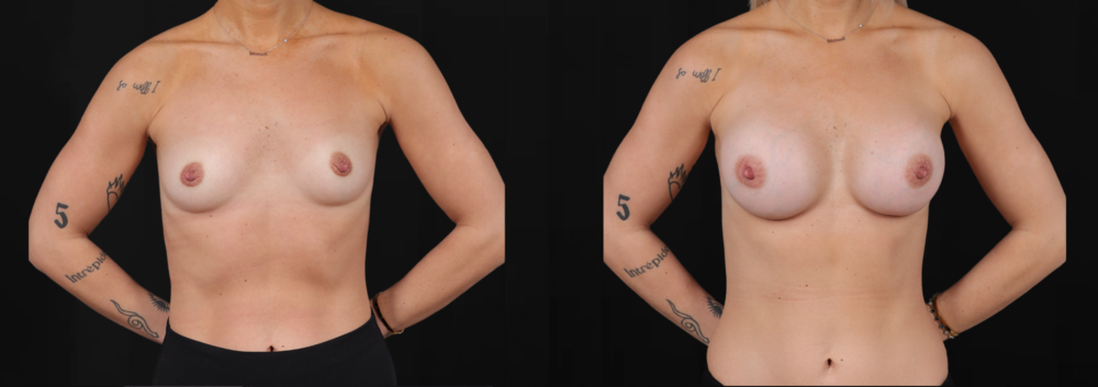 Breast Augmentation case #266366