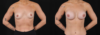 Breast Augmentation case #266366 slider thumbnail