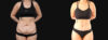 Tummy Tuck case #266607 slider thumbnail