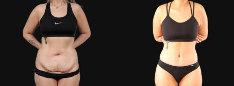 Tummy Tuck case #266607
