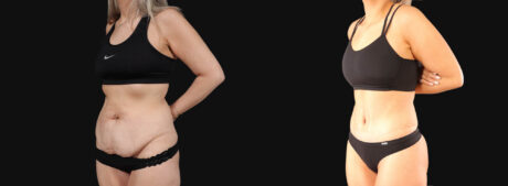 Tummy Tuck case #266607