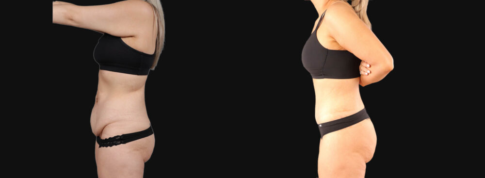 Tummy Tuck case #266607