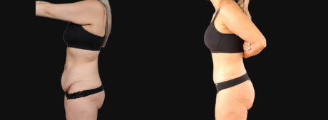 Tummy Tuck case #266607