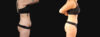 Tummy Tuck case #266607 slider thumbnail