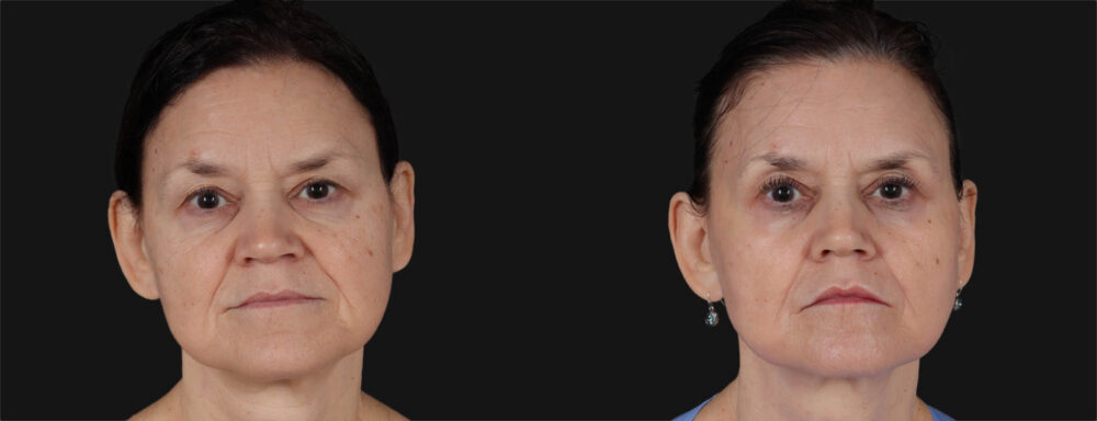 Co2 Laser case #266500