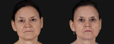 Co2 Laser case #266500