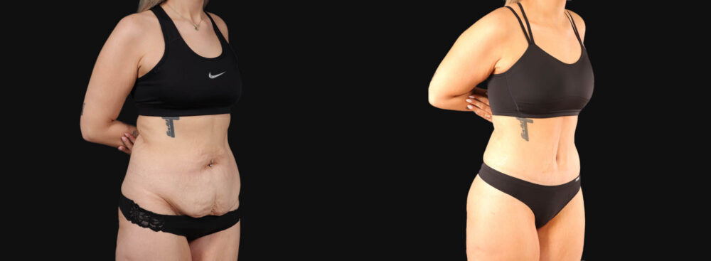 Tummy Tuck case #266607