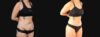 Tummy Tuck case #266607 slider thumbnail