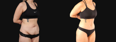 Tummy Tuck case #266607