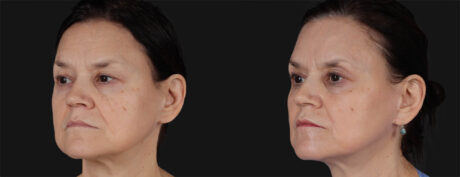 Co2 Laser case #266500