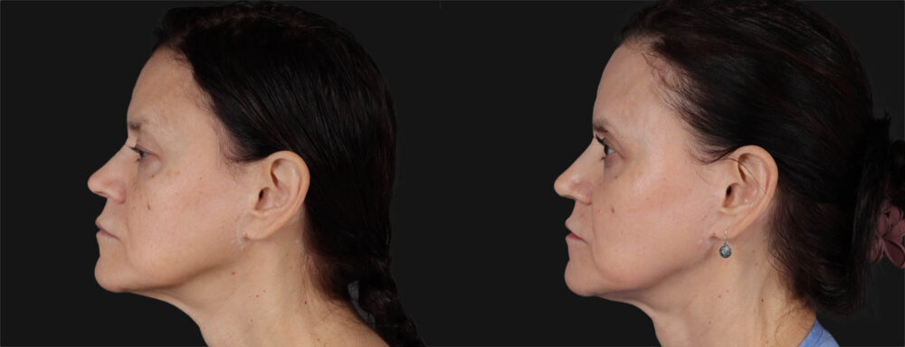 Co2 Laser case #266500