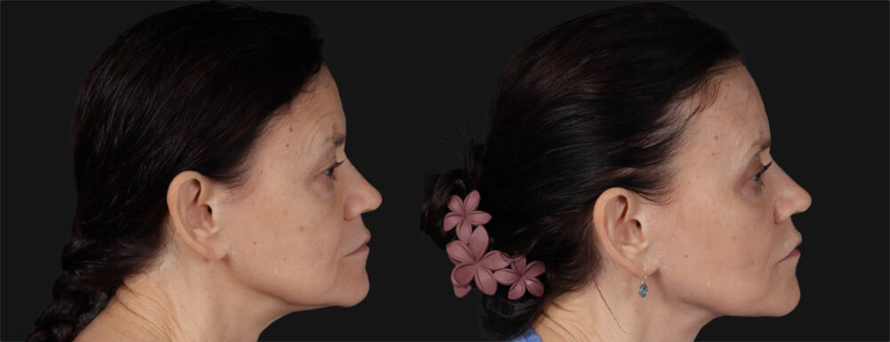 Co2 Laser case #266500