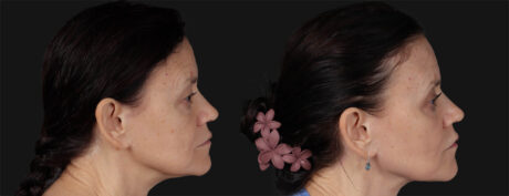 Co2 Laser case #266500